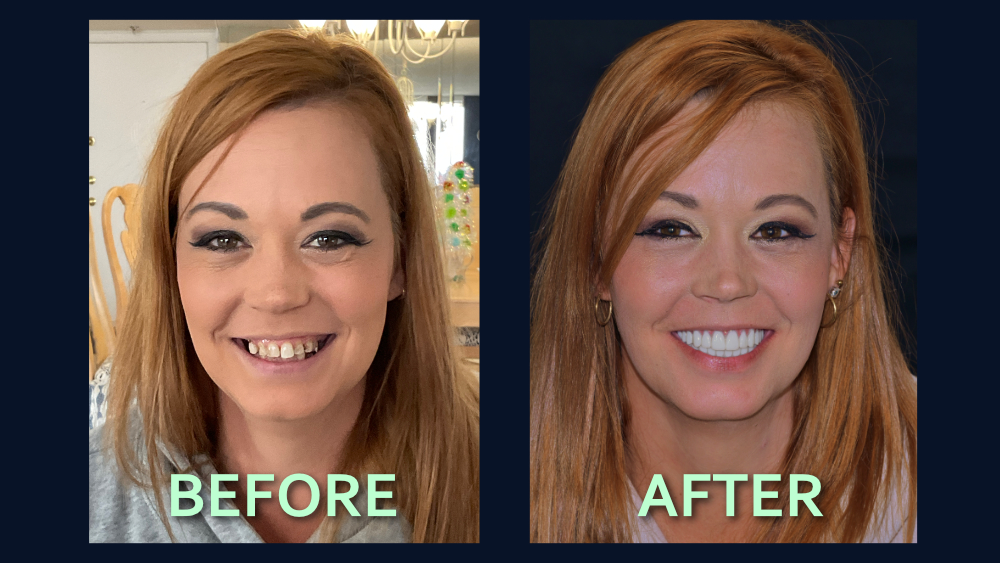 Before and after Dental Implants